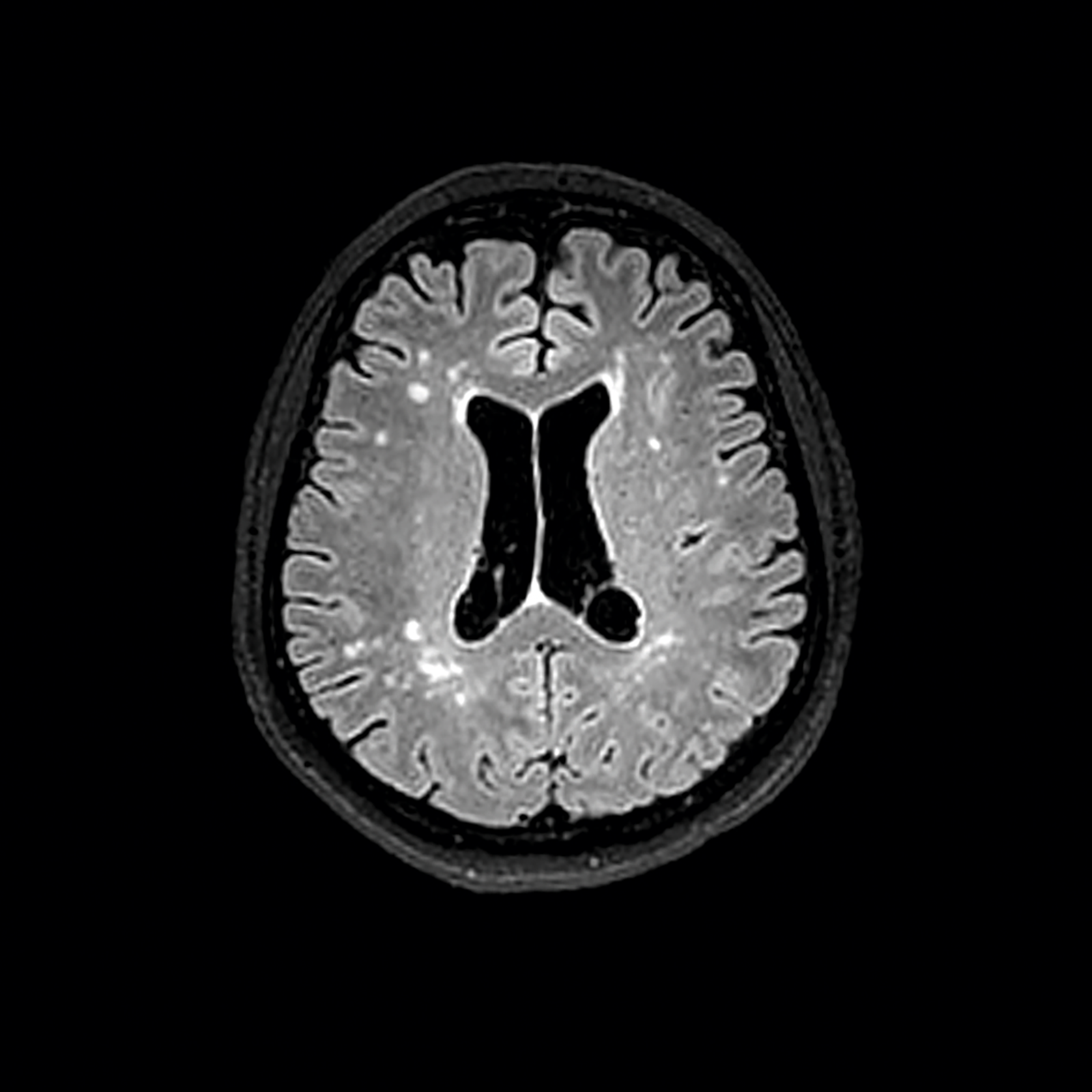 MRI-afbeelding (zwart-wit) stroke-patiënte met migraine met White Matter Lesions